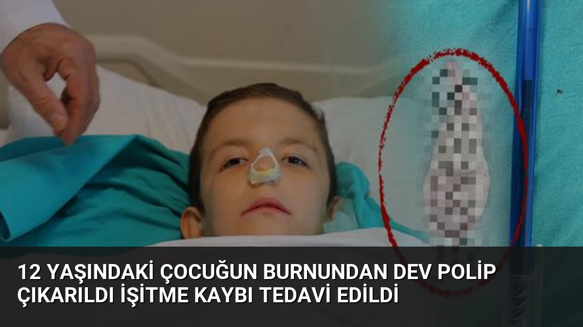 12 Yaşındaki Çocuğun Burnundan Dev Polip Çıkarıldı İşitme Kaybı Tedavi Edildi