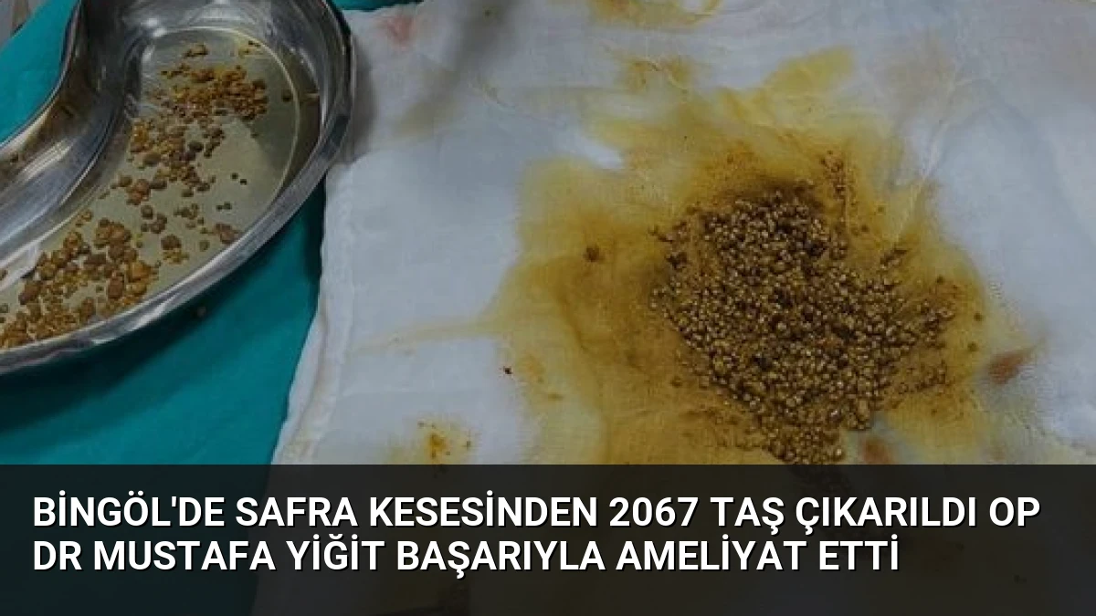 Bingöl’de Safra Kesesinden 2067 Taş Çıkarıldı Op Dr Mustafa Yiğit Başarıyla Ameliyat Etti