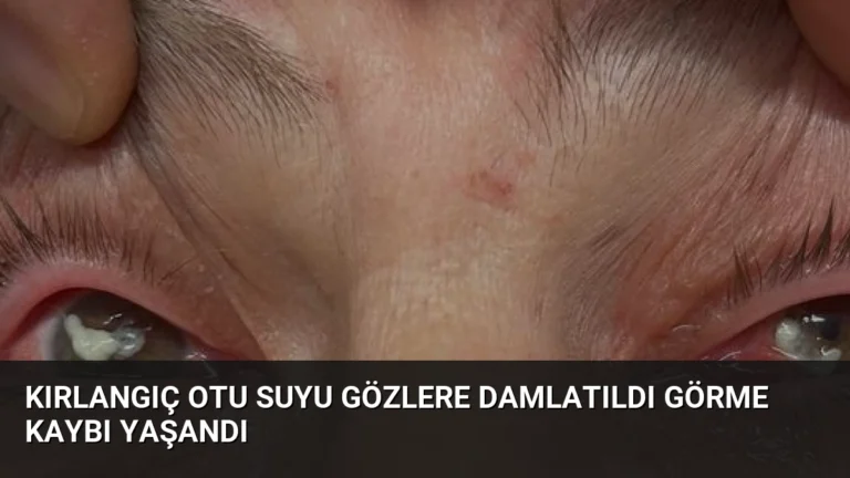 Kırlangıç Otu Suyu Gözlere Damlatıldı Görme Kaybı Yaşandı