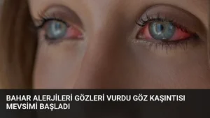Bahar Alerjileri Gözleri Vurdu Göz Kaşıntısı Mevsimi Başladı