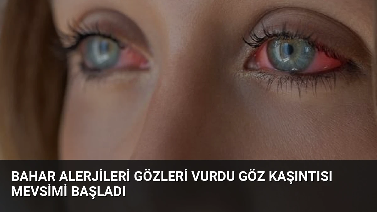 Bahar Alerjileri Gözleri Vurdu Göz Kaşıntısı Mevsimi Başladı